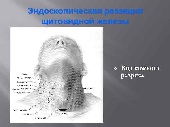 Эндоскопическая резекция щитовидной железы v Вид кожного разреза. 