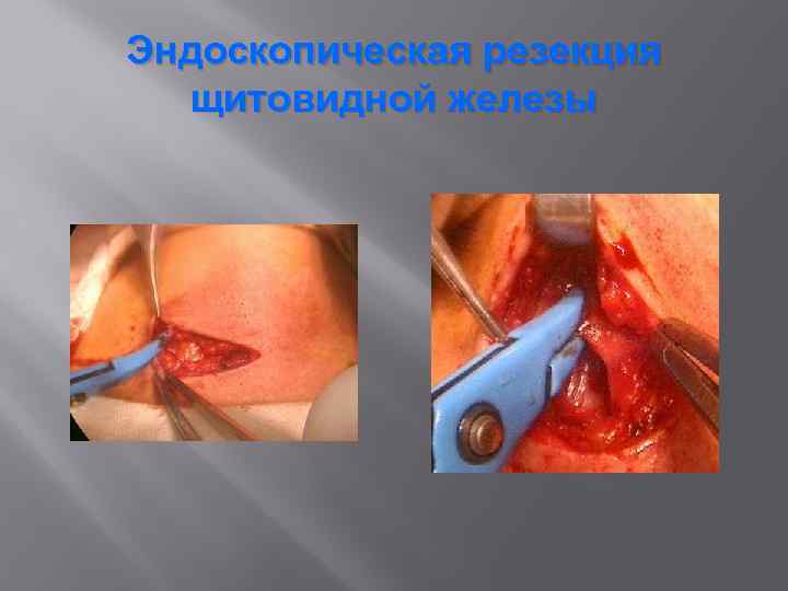 Эндоскопическая резекция щитовидной железы 