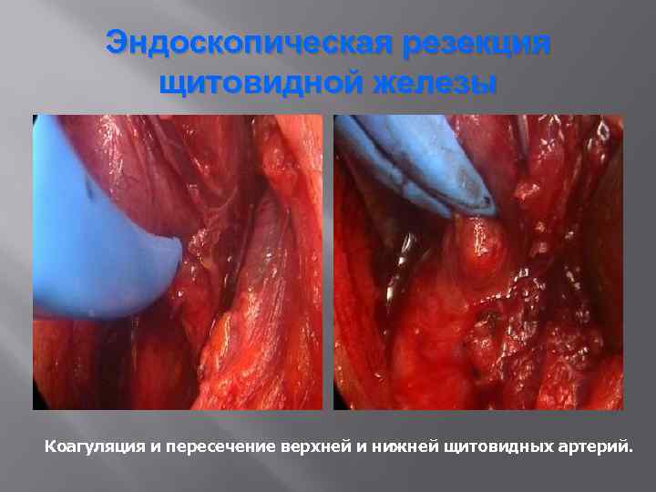 Эндоскопическая резекция щитовидной железы Коагуляция и пересечение верхней и нижней щитовидных артерий. 