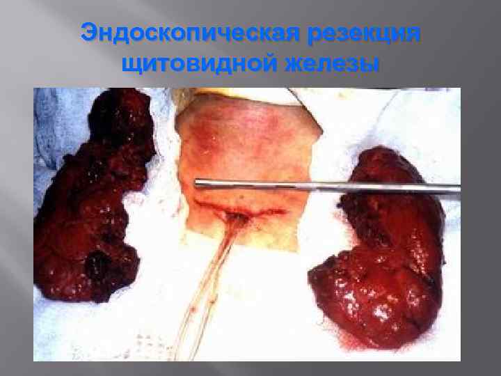Эндоскопическая резекция щитовидной железы 