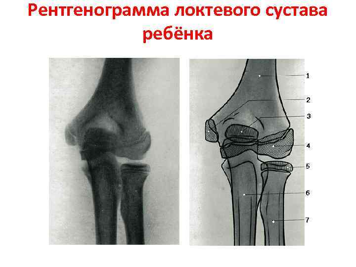 Левый локтевой сустав