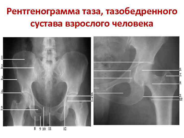 Рентгенограмма таза, тазобедренного сустава взрослого человека 