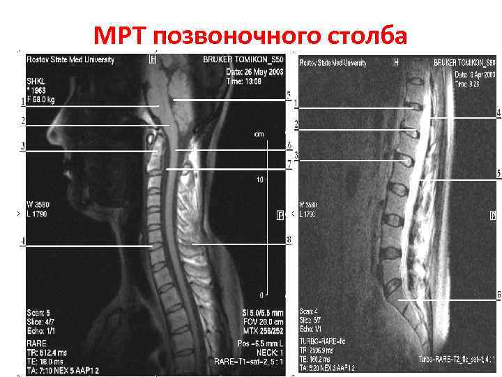 МРТ позвоночного столба 