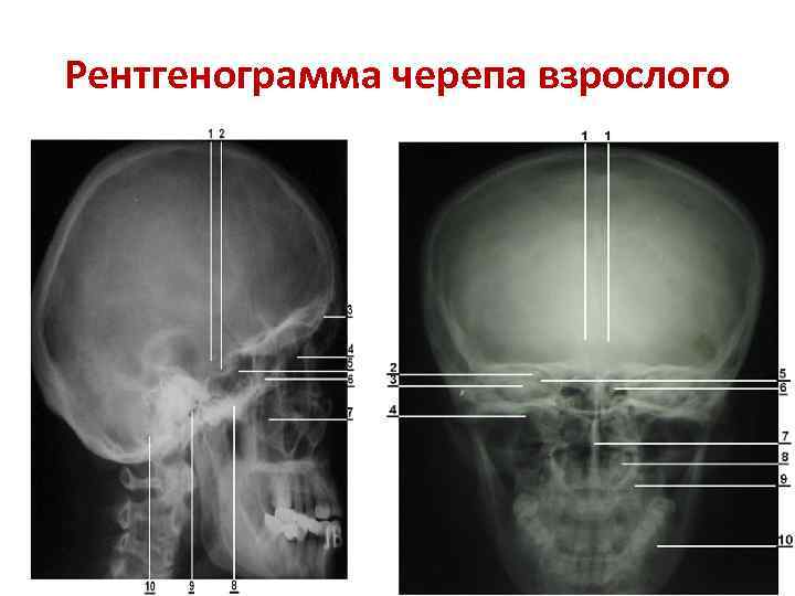Рентгенограмма черепа взрослого 