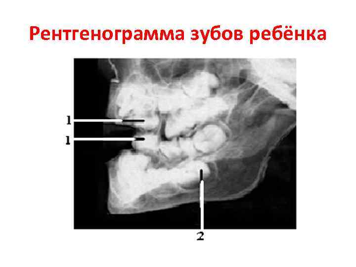 Рентгенограмма зубов ребёнка 