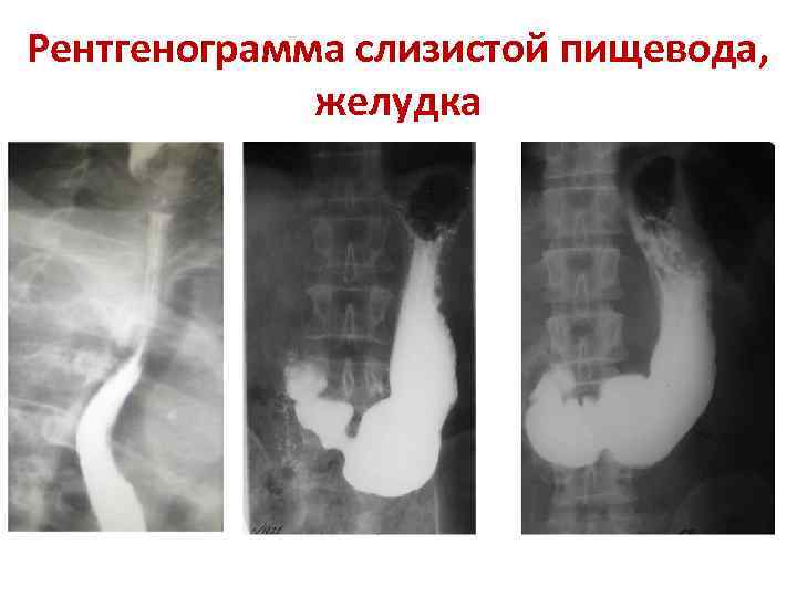 Рентгенограмма слизистой пищевода, желудка 