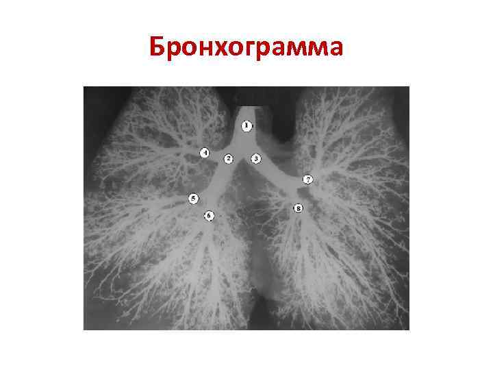 Бронхограмма 