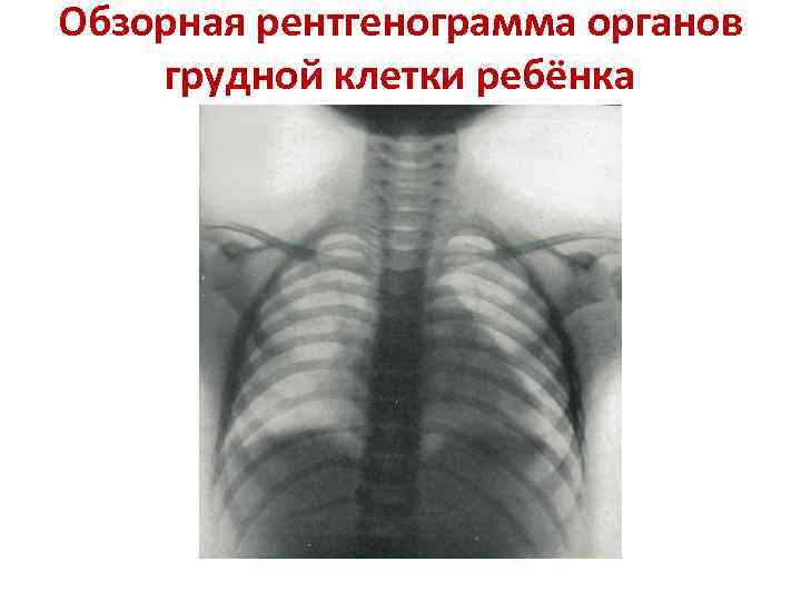 Обзорная рентгенограмма органов грудной клетки ребёнка 