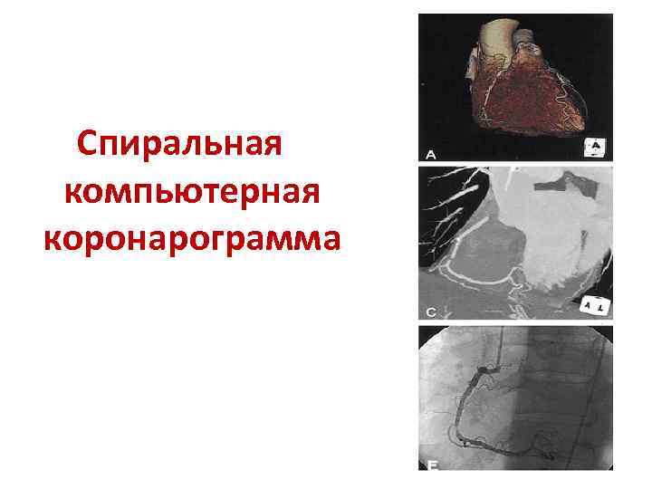 Спиральная компьютерная коронарограмма 