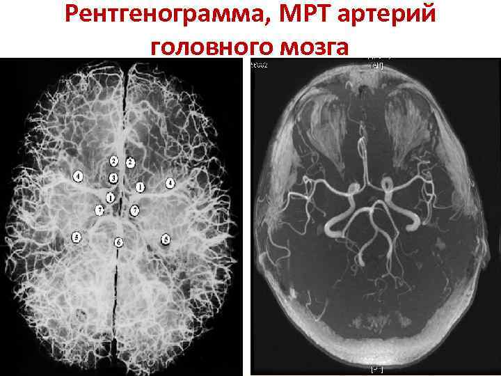 Рентгенограмма, МРТ артерий головного мозга 