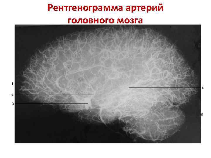 Рентгенограмма артерий головного мозга 