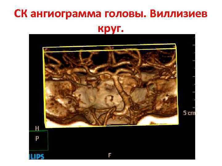 СК ангиограмма головы. Виллизиев круг. 