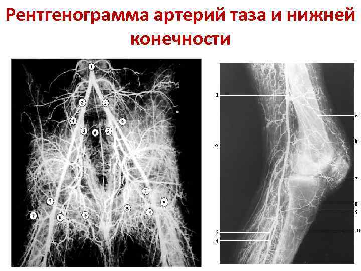 Рентгенограмма артерий таза и нижней конечности 