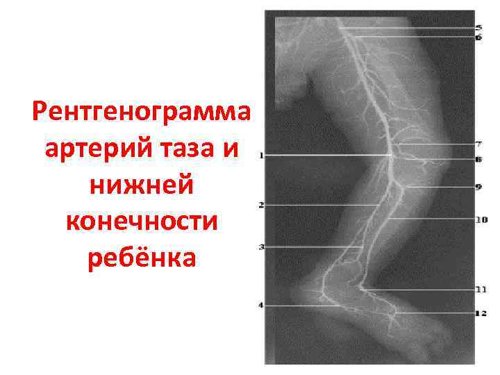 Рентгенограмма артерий таза и нижней конечности ребёнка 