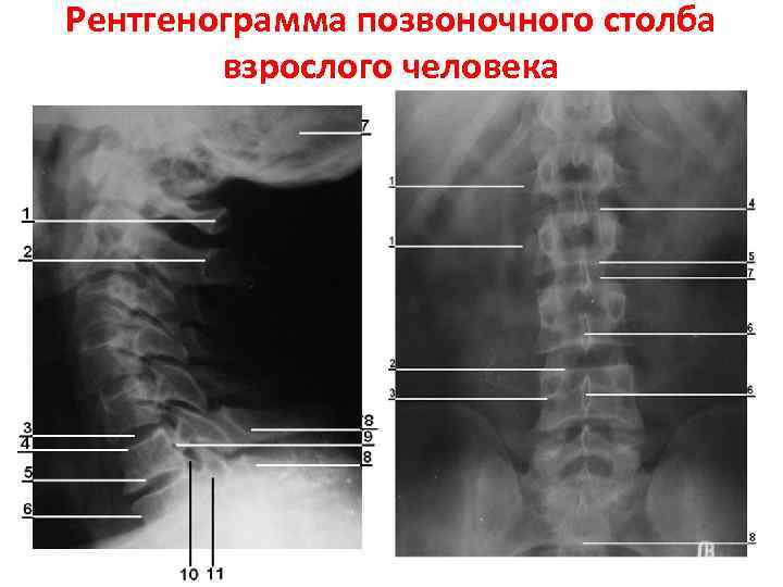 Рентгенограмма позвоночного столба взрослого человека 