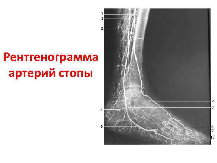 Рентгенограмма артерий стопы 