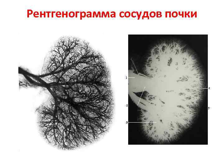 Рентгенограмма сосудов почки 