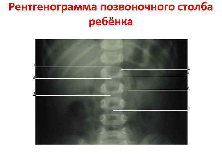 Рентгенограмма позвоночного столба ребёнка 