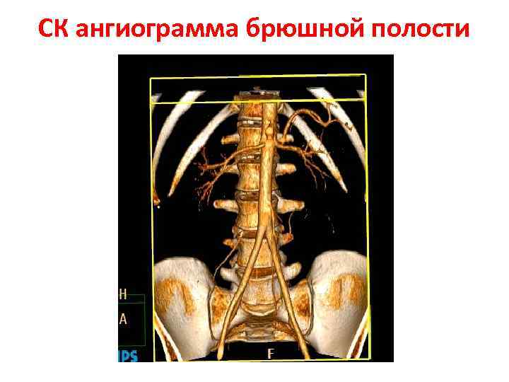 СК ангиограмма брюшной полости 