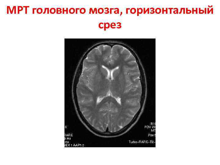 МРТ головного мозга, горизонтальный срез 