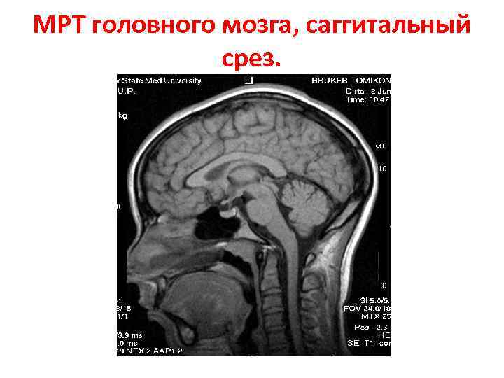 МРТ головного мозга, саггитальный срез. 