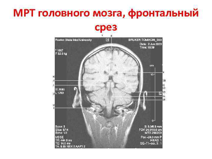 МРТ головного мозга, фронтальный срез 