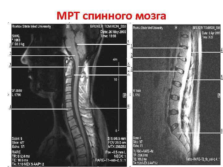 МРТ спинного мозга 