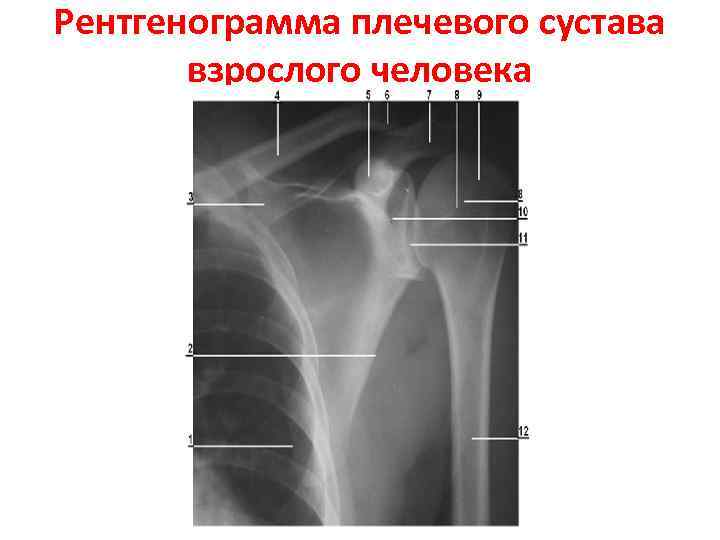 На рисунках представлены рентгенограммы суставов человека какой цифрой отмечена рентгенограмма