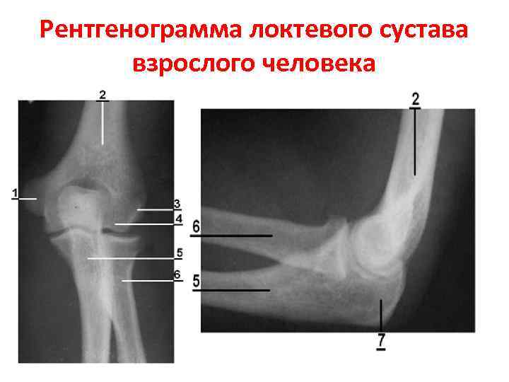 Рентгенограмма локтевого сустава взрослого человека 