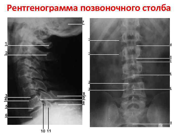 Рентгенография грудного отдела позвоночника