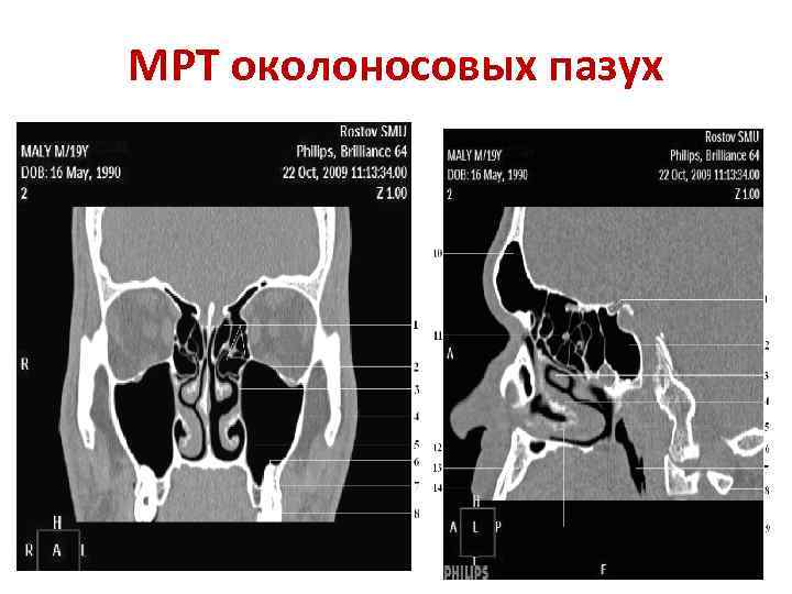 Кт околоносовых пазух картинки