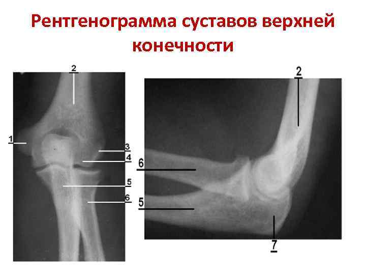 Рентгенограмма суставов верхней конечности 