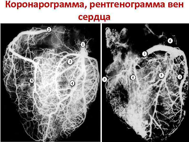 Коронарограмма, рентгенограмма вен сердца 