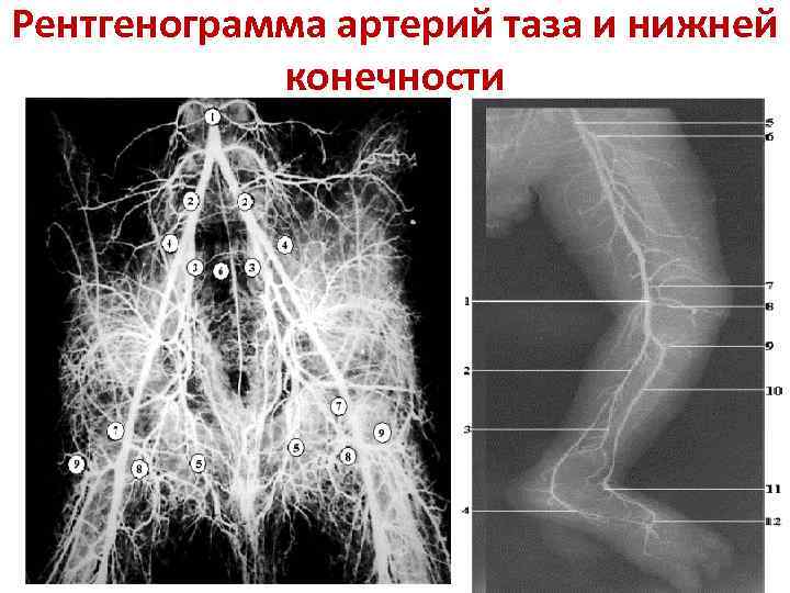 Рентгенограмма артерий таза и нижней конечности 