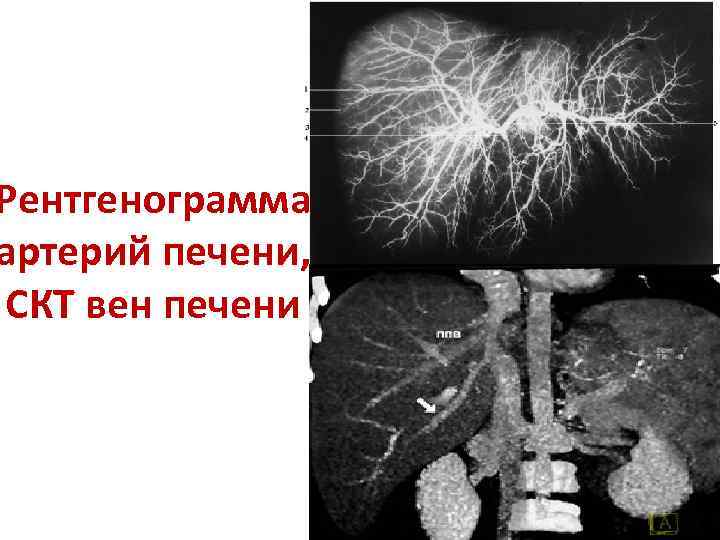 Схема рентгенограммы контрастированного пищевода