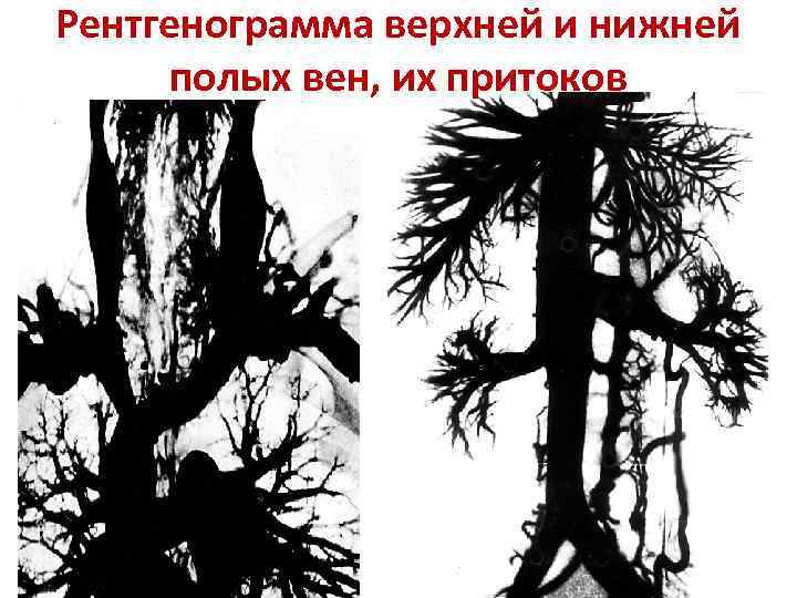 Рентгенограмма верхней и нижней полых вен, их притоков 