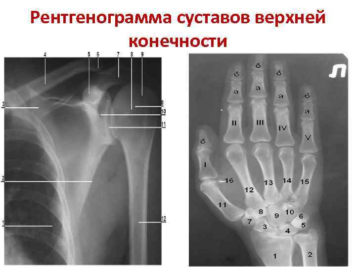 На рисунках представлены рентгенограммы суставов человека какой цифрой отмечена рентгенограмма