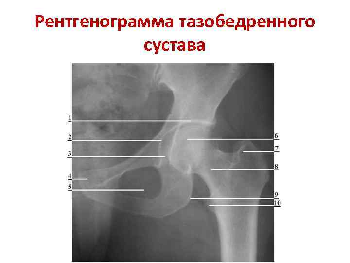 Рентгенограмма тазобедренного сустава 