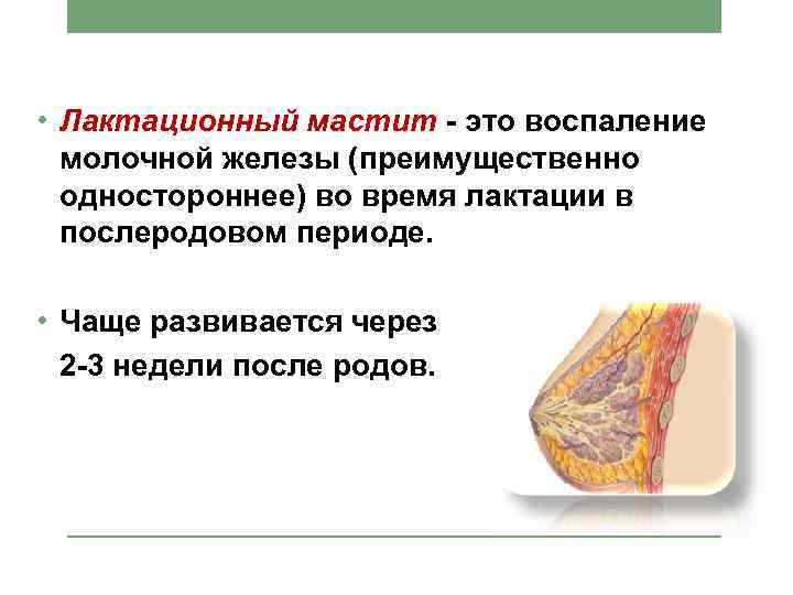  • Лактационный мастит - это воспаление молочной железы (преимущественно одностороннее) во время лактации