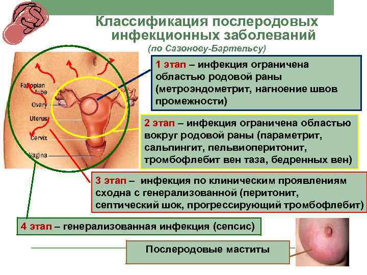 Классификация послеродовых инфекционных заболеваний (по Сазонову-Бартельсу) 1 этап – инфекция ограничена областью родовой раны