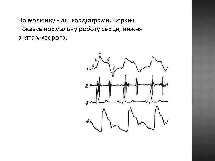 На малюнку - дві кардіограми. Верхня показує нормальну роботу серця, нижня знята у хворого.