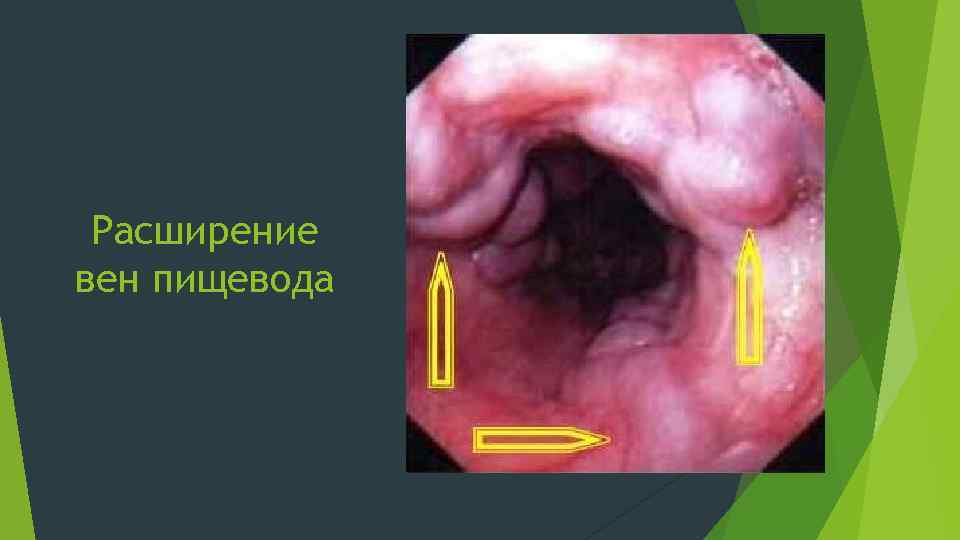 Расширение вен пищевода 