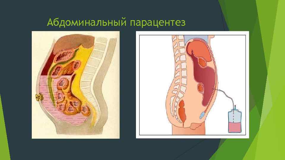 Абдоминальный парацентез 