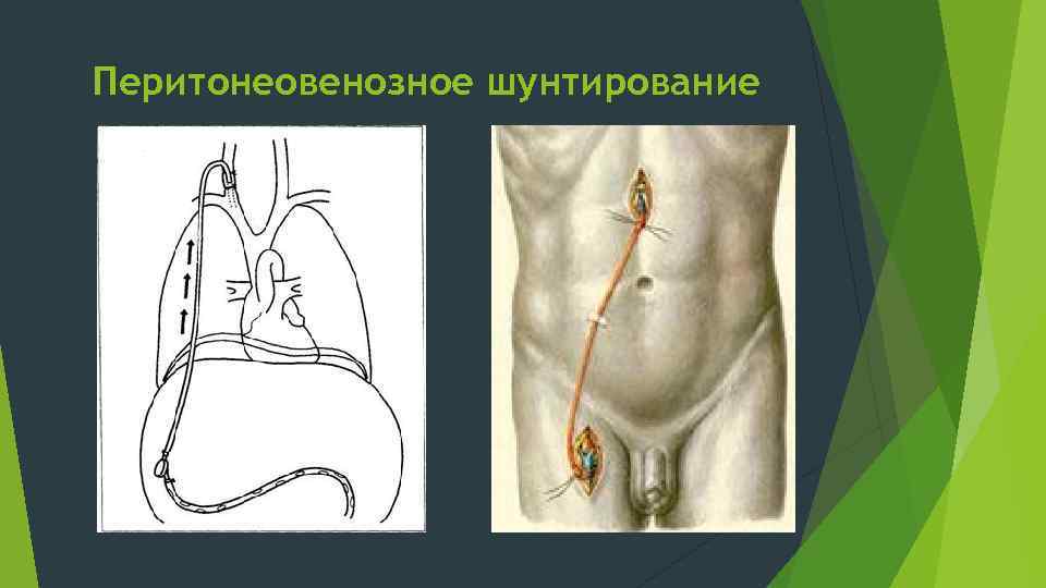 Перитонеовенозное шунтирование 