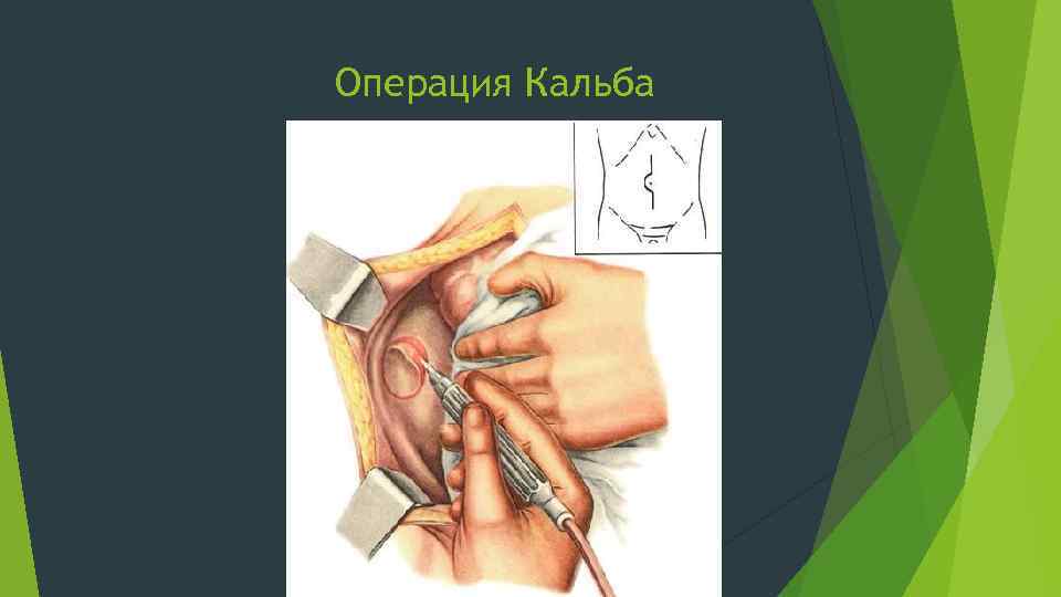 Операция Кальба 