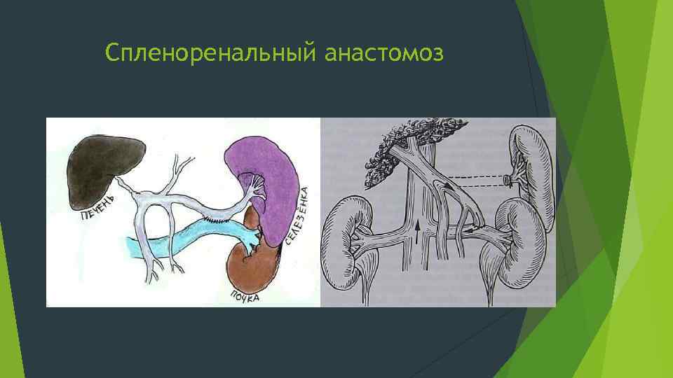 Спленоренальный анастомоз 