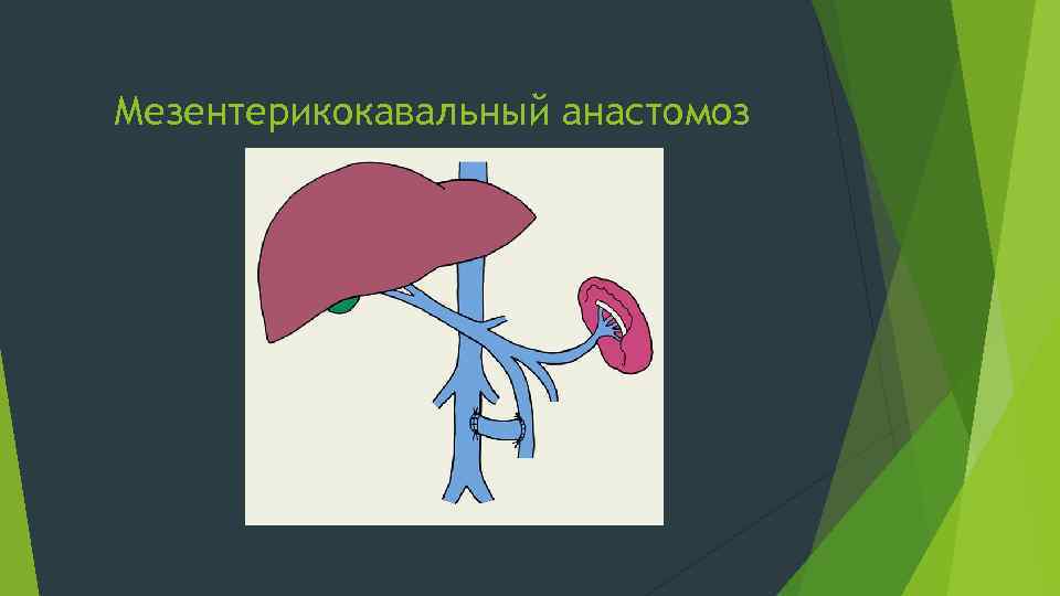 Мезентерикокавальный анастомоз 