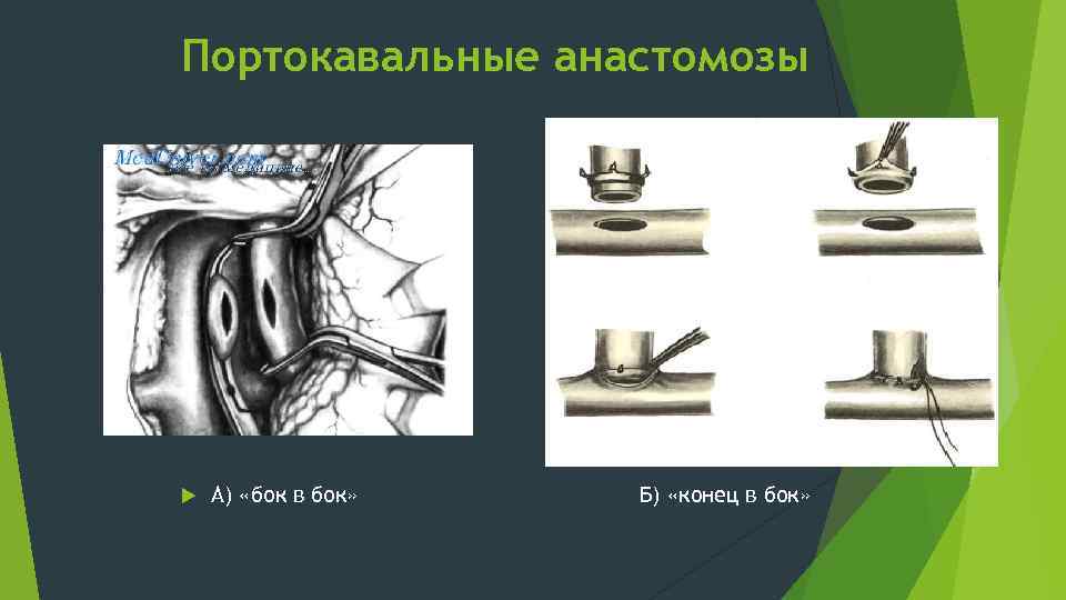 Портокавальные анастомозы А) «бок в бок» Б) «конец в бок» 