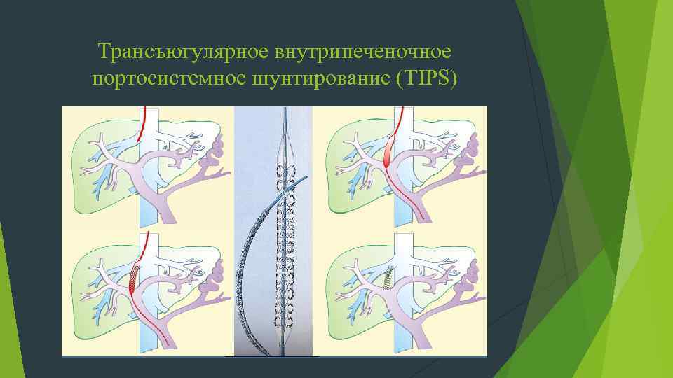 Трансъюгулярное внутрипеченочное портосистемное шунтирование (TIPS) 