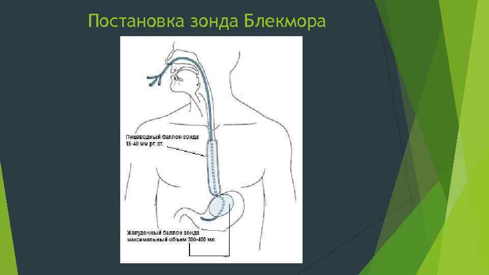 Постановка зонда Блекмора 